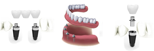 ایمپلنت در دندان پزشکی