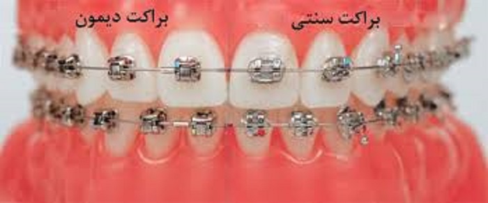 براکت دیمون