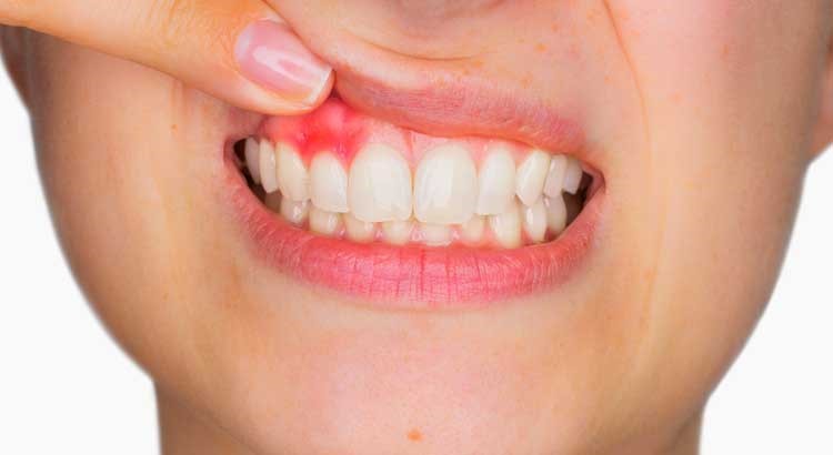 تفاوت بین بیماری ژنژیویت و پریودنتیت