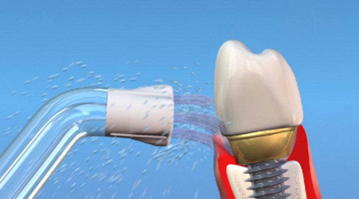 شستشوی لثه با شستشو دهنده‌های دهان یا Oral Irrigator