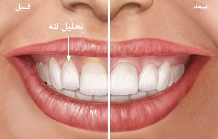 تحلیل لثه چیست و درمان آن چگونه انجام می شود؟ - کلینیک دندانپزشکی محتشم اصفهان