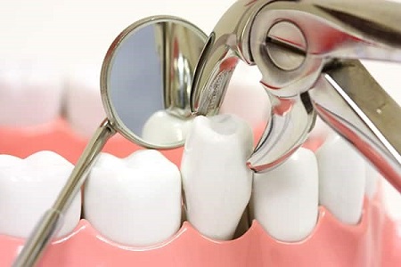 انواع روش های کشیدن دندان
