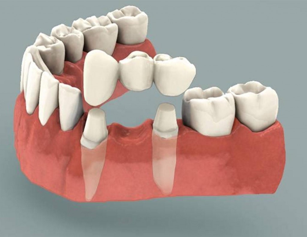 انواع پروتز های ثابت دندان