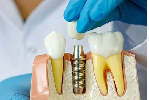 روش‌های ایمپلنت دندان
