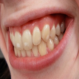 لکه های سفید دندانی