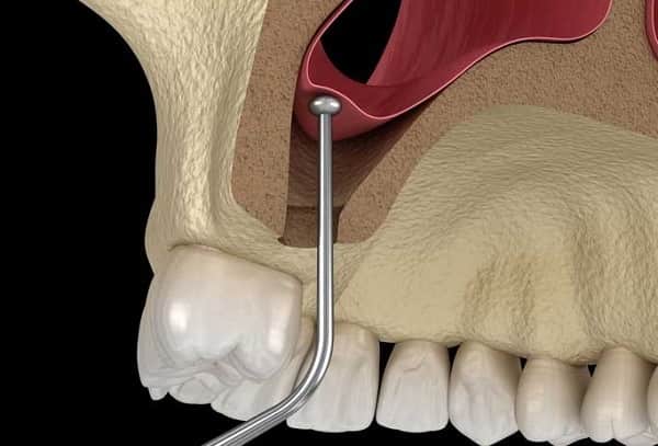 چه افرادی به جراحی لیفت سینوس نیاز دارند؟