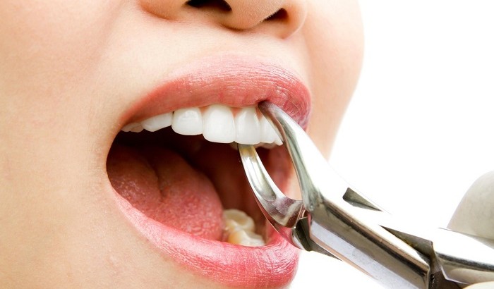کشیدن دندان بدون درد در جهت رفع عفونت ناشی از پوسیدگی پیش رونده
